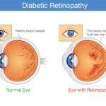 Diabetes and Your Eyes: What You Need to Know