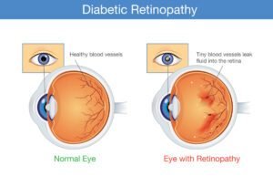Diabetes and Your Eyes: What You Need to Know