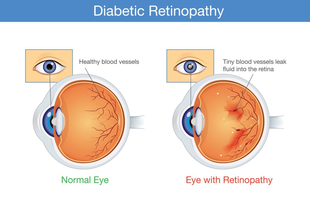 Diabetes and Your Eyes: What You Need to Know